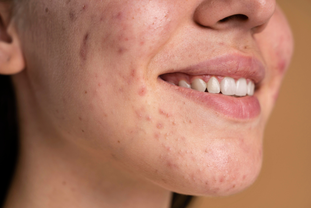 Can You See an Endocrinologist for Hormonal Acne?